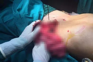 Cứu sống bệnh nhân bị máy cưa gỗ chém thủng bụng