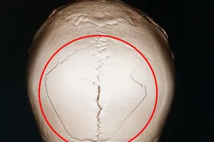 Nứt sọ suốt 2 ngày vẫn không hay biết