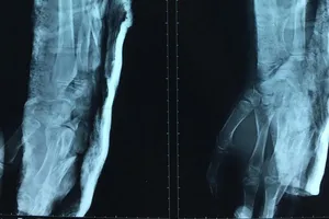 Cứu bệnh nhi bị chân vịt ghe chém gãy xương cánh tay 