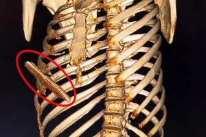 Cứu sống bệnh nhân suýt tử vong do dao đâm thủng gan