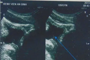 Tự lấy sỏi thận qua đường niệu bằng… cọng cỏ