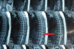 Phẫu thuật thành công cho bệnh nhân u tủy sống ngực