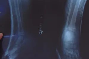 Rách da, gãy gót do kẹt chân vào căm xe máy