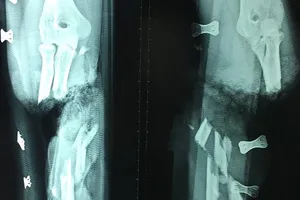 Vấp ngã khi khiêng giấy, cô gái trẻ bị dao cắt lìa tay