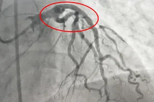 BV công, tư bắt tay cứu anh xe ôm bị nhồi máu cơ tim