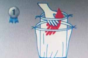 Mất tay, chân do bảo quản không đúng phần đứt lìa 