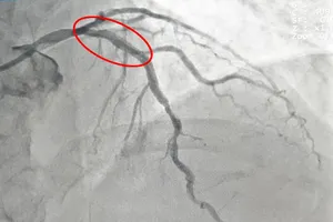 Bị nhồi máu cơ tim cấp khi đang uống bia