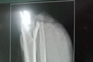 Ngồi trong ô tô cũng bị đứt lìa đùi trái