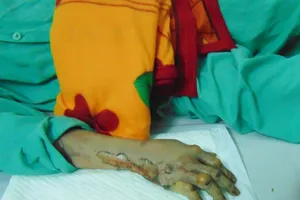 Hai mẹ con bị bỏng trong vụ cháy