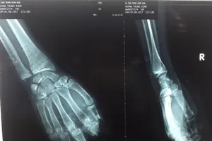 Bỏ quên 4 ngón tay đứt lìa trong xưởng cưa