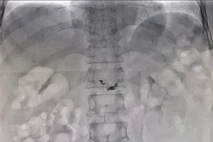 Tưởng đâu đau dạ dày, té ra mắc bệnh hiếm