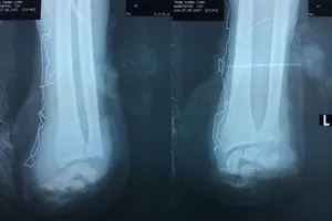 Một tay đứt lìa, một tay lủng lẳng do bị chém