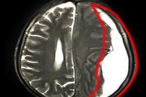 Suýt mất mạng do máu tụ dưới màng cứng mạn tính