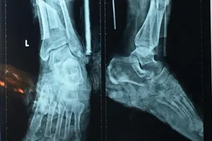 Sơ ý, cụ ông bị máy cắt cỏ chém suýt lìa cẳng chân