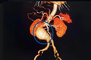 Có khối u vùng bụng, hãy nghĩ tới phình động mạch chủ