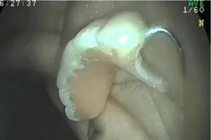 Nhiều người thủng bụng do xài… đồ giả 