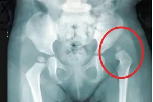 Trật khớp háng: Cần chữa sớm để trẻ không vẹo cột sống