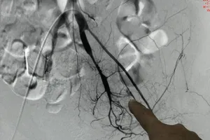 Bệnh nhân liên tục chảy máu không rõ nguyên nhân