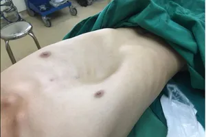 Khổ sở vì cái hố sâu trước ngực