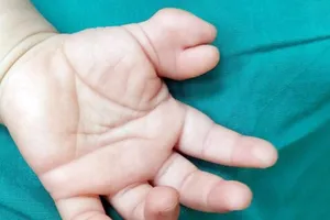 Cắt bỏ ngón tay 'vô duyên' cho bé gái 13 tháng tuổi