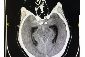 Tưởng đau đầu do làm đêm, té ra bị xuất huyết màng não