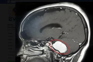 Cứu bệnh nhân có khối u não 'không giống ai'