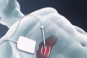 U gan ác tính nên điều trị bằng phương pháp nào?