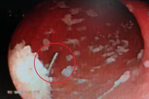 'Biểu diễn' không thành, kim may chui tọt vô bụng