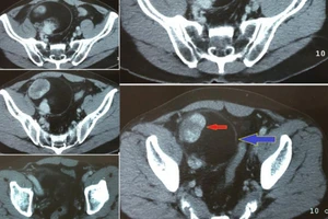 Bệnh nhân chảy máu ồ ạt ngay trên bàn mổ