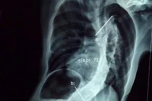 Phẫu thuật cho bệnh nhi có cột sống cong hình chữ S