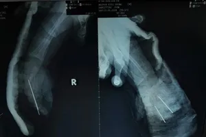 Bé 2 tuổi bị dây xích xe máy cắt đứt lìa bàn tay phải