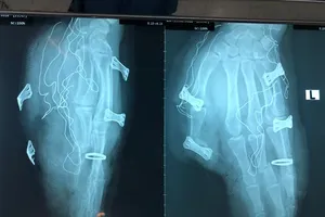 Bàn tay dập nát do pháo nổ