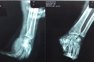 Lưỡi cưa máy cắt đứt lìa bàn tay trái