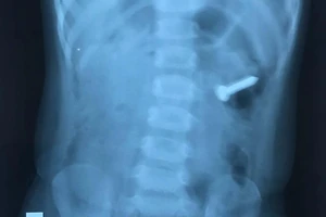 Bé gái 2 tuổi nuốt chiếc đinh ốc xoắn dài 3 cm