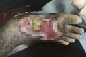 Xương bàn chân lộ ra ngoài do rắn độc cắn