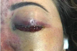 'Sờ gáy' spa làm mù mắt cô gái sau tiêm filler nâng mũi