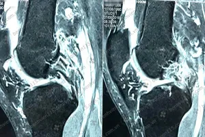 Đứt dây chằng, lỏng gối do té lúc đá banh