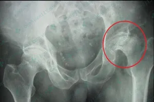 Hoại tử chỏm xương đùi vì uống rượu, hút thuốc quá nhiều