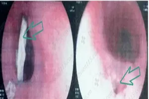 Suýt 'hết ăn Tết' vì cái xương gà