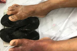 Phát hiện bị đái tháo đường nhờ… dép kẹp