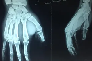 Nối thành công đốt ngón tay cái bị xích xe cắt đứt 