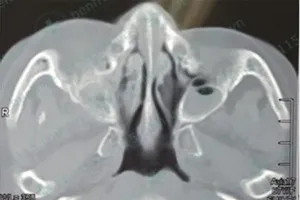 Nguy cơ tử vong vì viêm xoang trên bệnh nhân tiểu đường