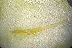 Thủng tá tràng vì vừa ngậm tăm vừa nói chuyện