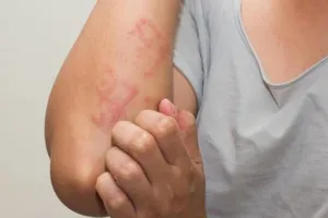 Những biểu hiện 'tố' bạn bị dị ứng thuốc