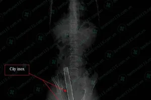 Vô bệnh viện cùng cây inox dài hơn 1m xuyên qua mông 