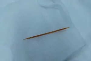 Tăm tre đâm xuyên gan, dạ dày suốt hai tháng mà không biết