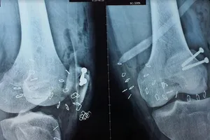 Người đàn ông bị chân vịt ca nô chém lộ xương chân