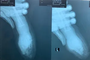 Người lớn sơ sẩy vài giây, bốn ngón tay bé một tuổi bị đứt lìa