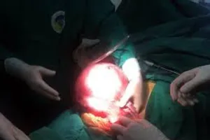  Sống cùng khối u nặng trên 6 kg suốt nhiều năm