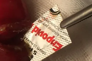 Lại một người thủng ruột do 'nuốt nhầm' vỏ thuốc